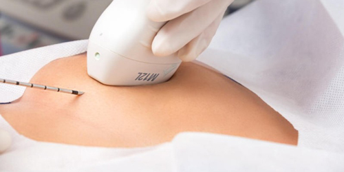 Biopsia de mama guiada por imagen